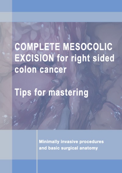 'Cover von Complete mesocolic excision for right sided colon cancer.'-Cover